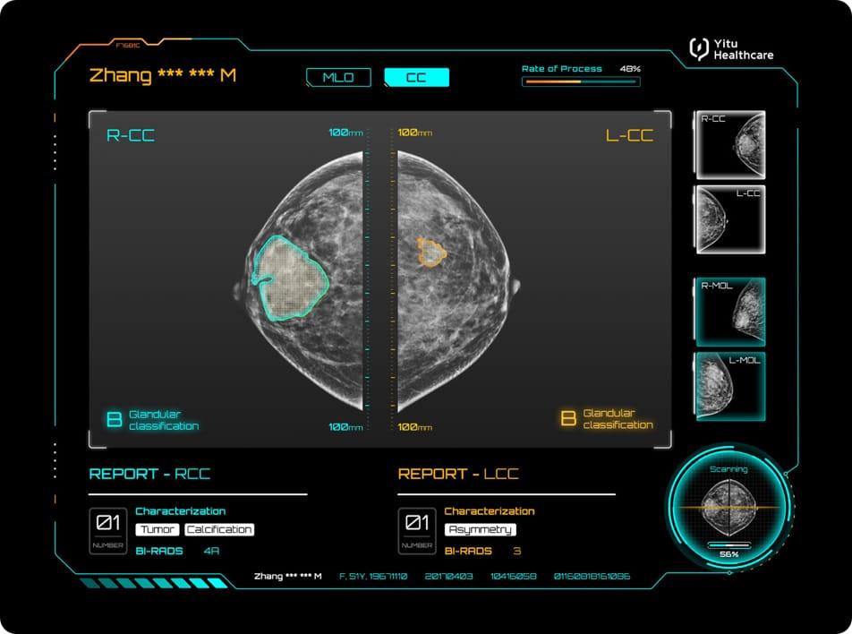 care.aiTM 乳腺X線智能診斷系統